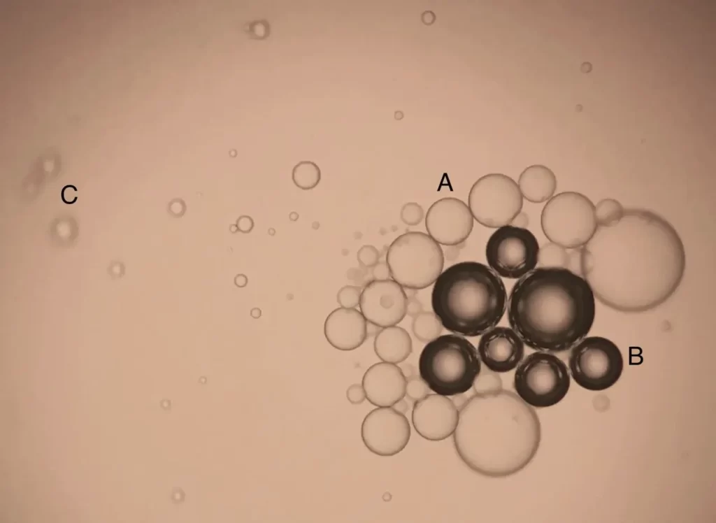 Silicone oil in eye